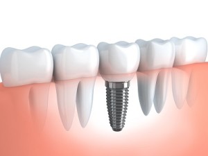 Dental Implants Los Angeles