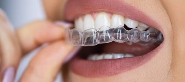 featured image for: can Invisalign fix an overbite