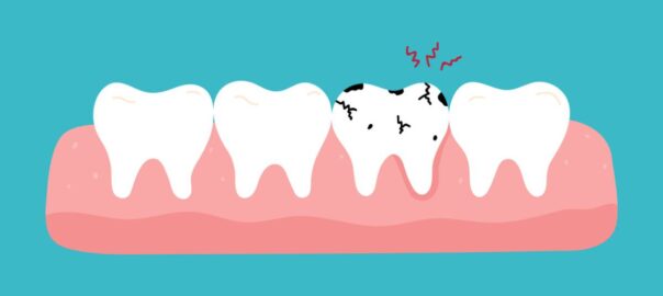 concept for cavities between two teeth