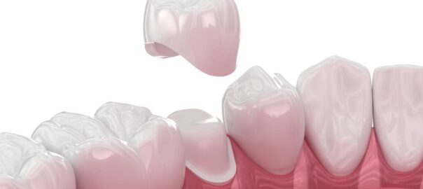 Featured image for How Long Do Dental Crowns Last?