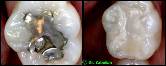 before and after restorative dentistry