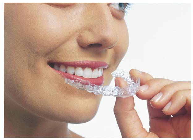 Are Invisible Braces Worth It? How They Work?