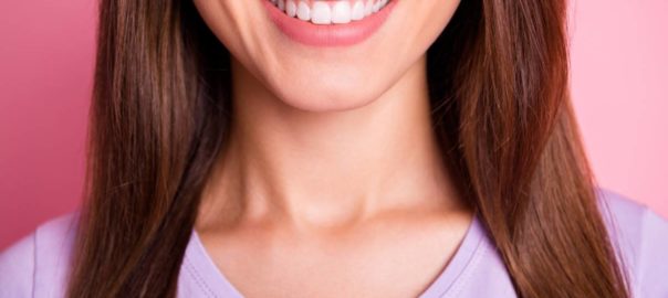 Woman with dental veneers